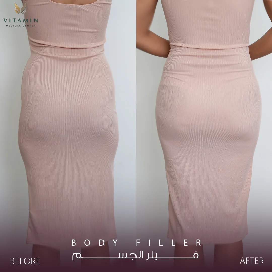 Before and after body filler, back view
