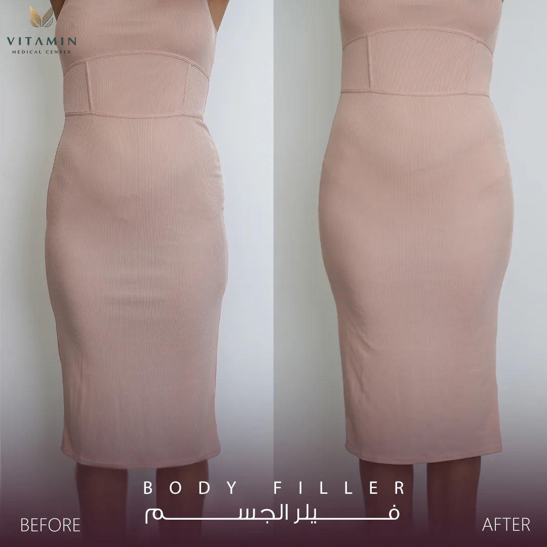 Before and after body filler, front view