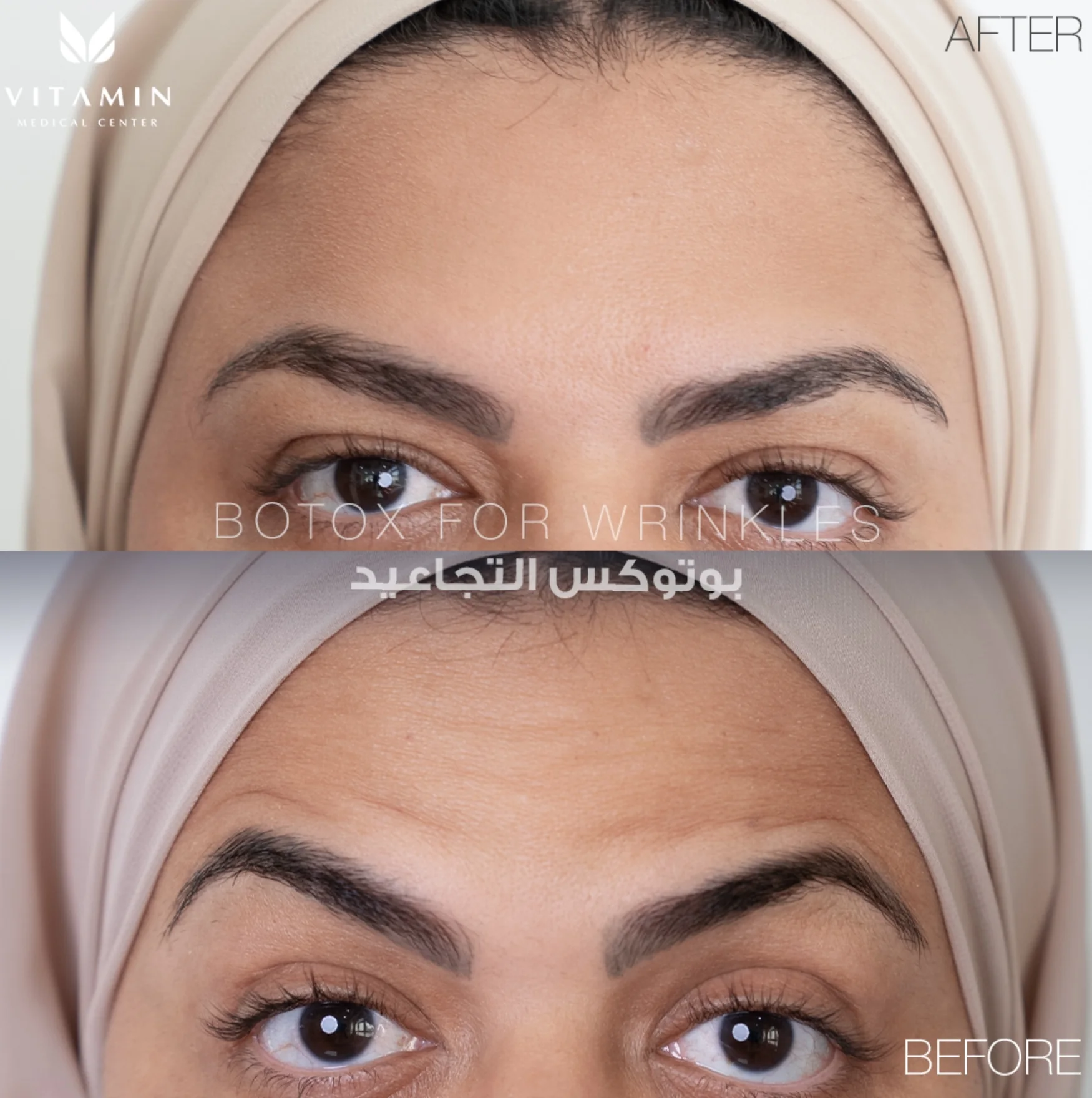 Before and after Botox treatment for forehead wrinkles