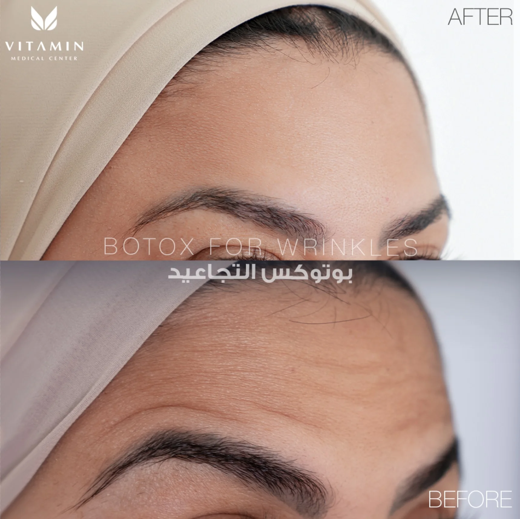 Before and after Botox treatment for forehead lines, three-quarter view