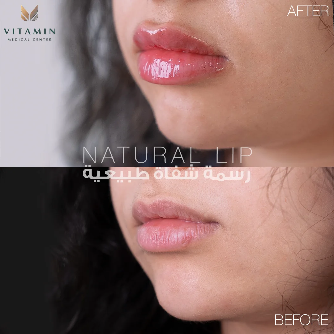 Before and after natural lip filler, three-quarter view