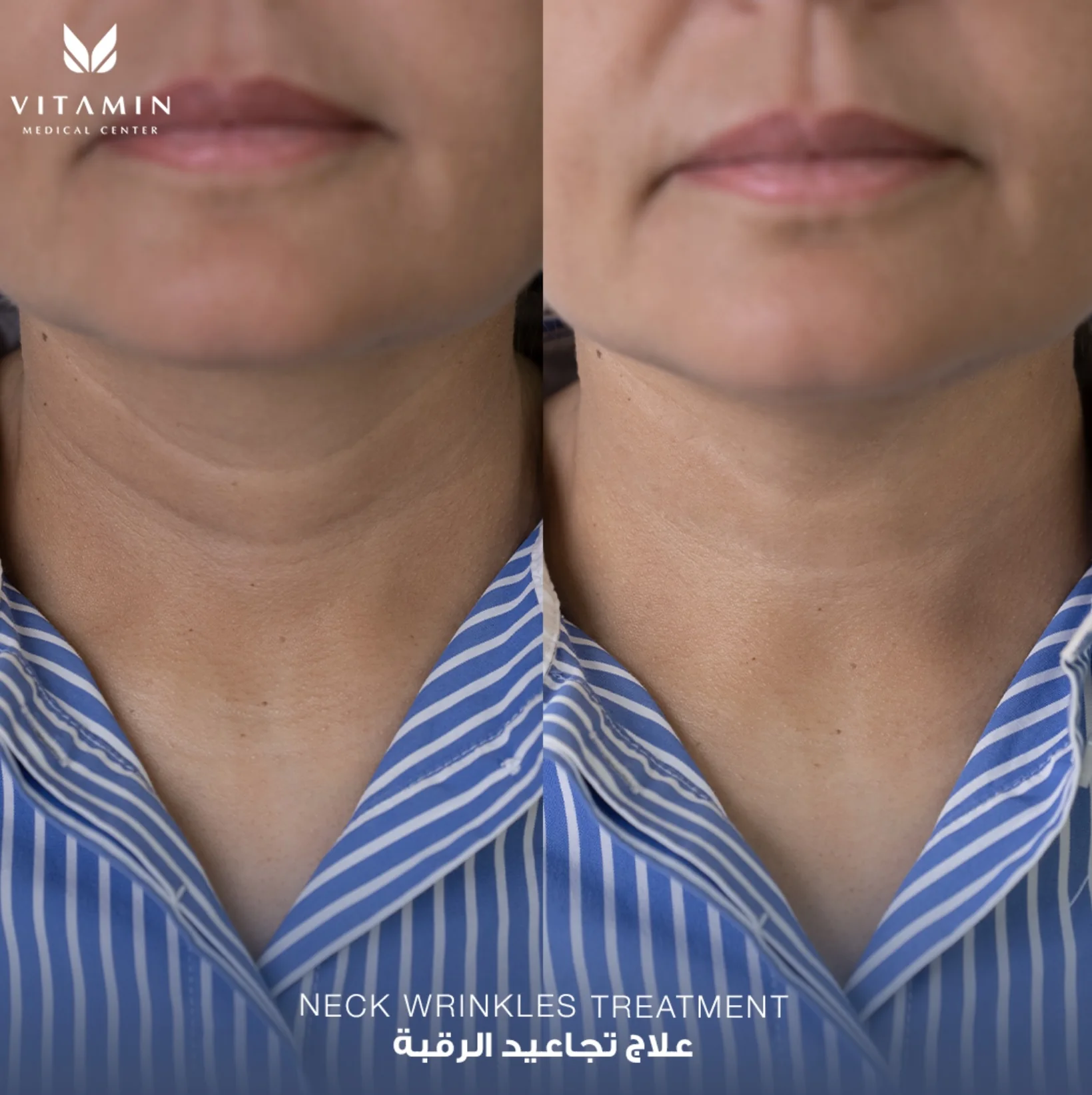 Before and after treatment for neck wrinkles